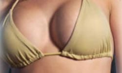 Picture of a woman, happy with her breast lift with implants procedure she had with Top Plastic Surgeons in beautiful San José, Costa Rica.  The woman is facing the camera and wearing a mustard yellow bikini top.