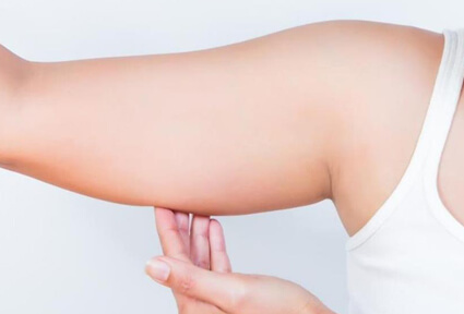 Picture of a woman facing the camera and happy with the perfect arms liposuction procedure she had with top plastic surgeons in beautiful San José, Costa Rica.  She is wearing a white top and holding her hand to one arm,  showing the area of the surgery.